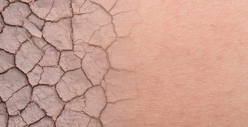 ¿Qué causa la piel seca?
